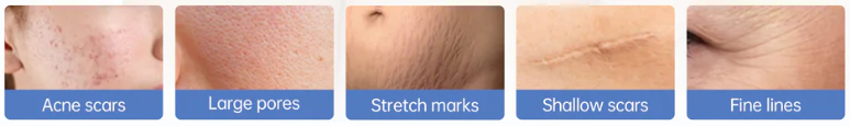 microneedling for acne scars, large pores, stretch marks, shallow scars and fine lines