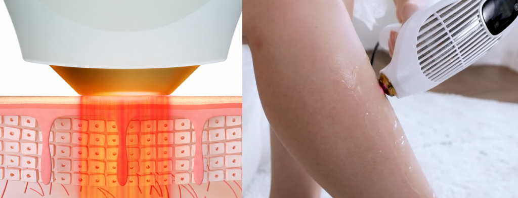 split image showing how the ViQure S-LD works to remove hair on dark skin tone