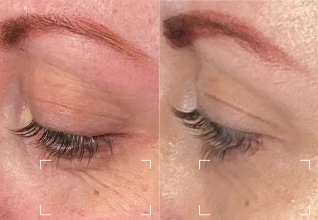 dermrays before and after photo